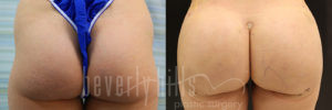 Brazilian Butt Lift Patient 33 Before & After - Thumbnail