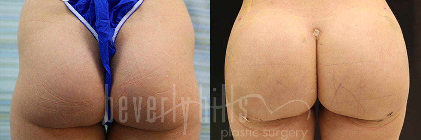 Brazilian Butt Lift Patient 33 Before & After