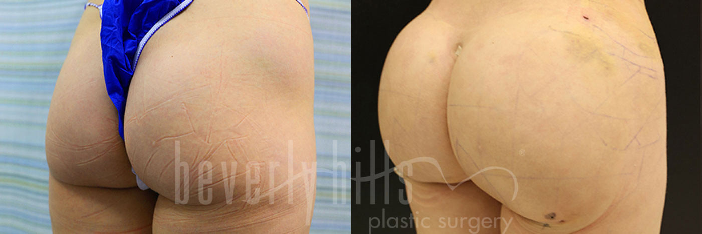 Brazilian Butt Lift Patient 33 Before & After
