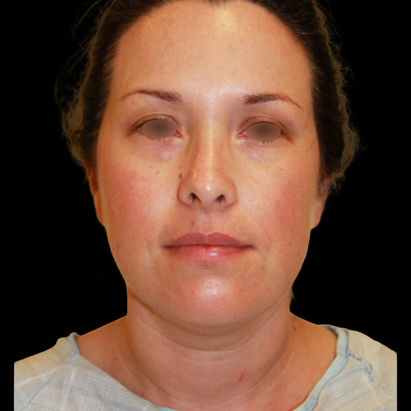 Case--3876 | Before Face Liposuction