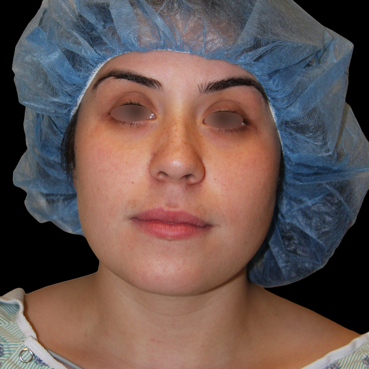 Case--6019 | Before Face Liposuction