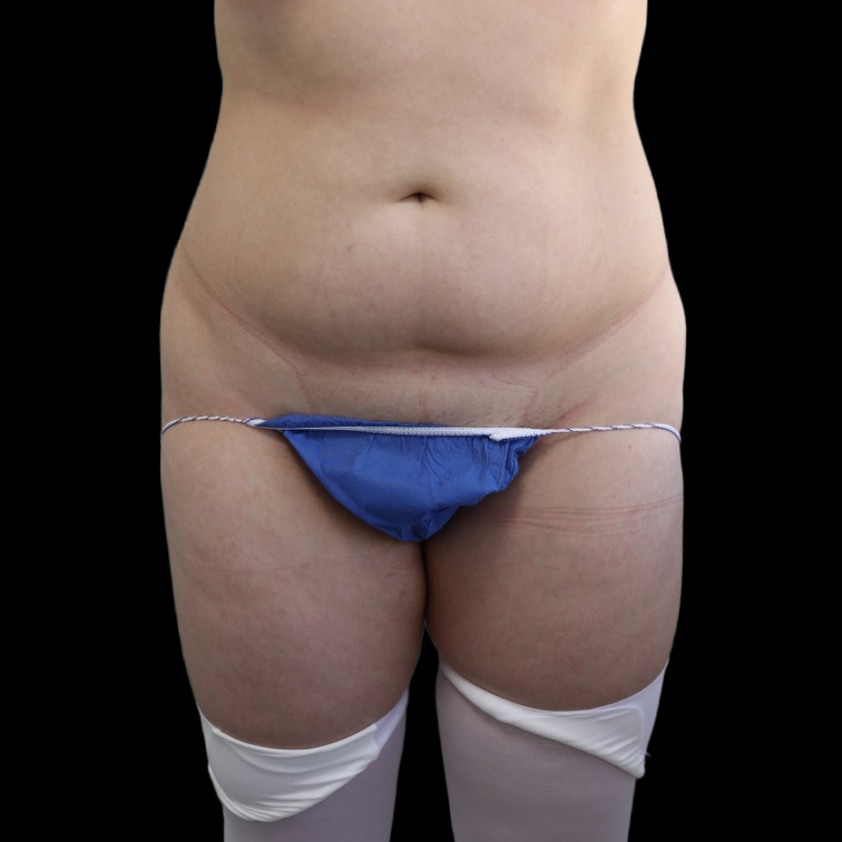 Case--9300 | Before Brazilian Butt Lift 2