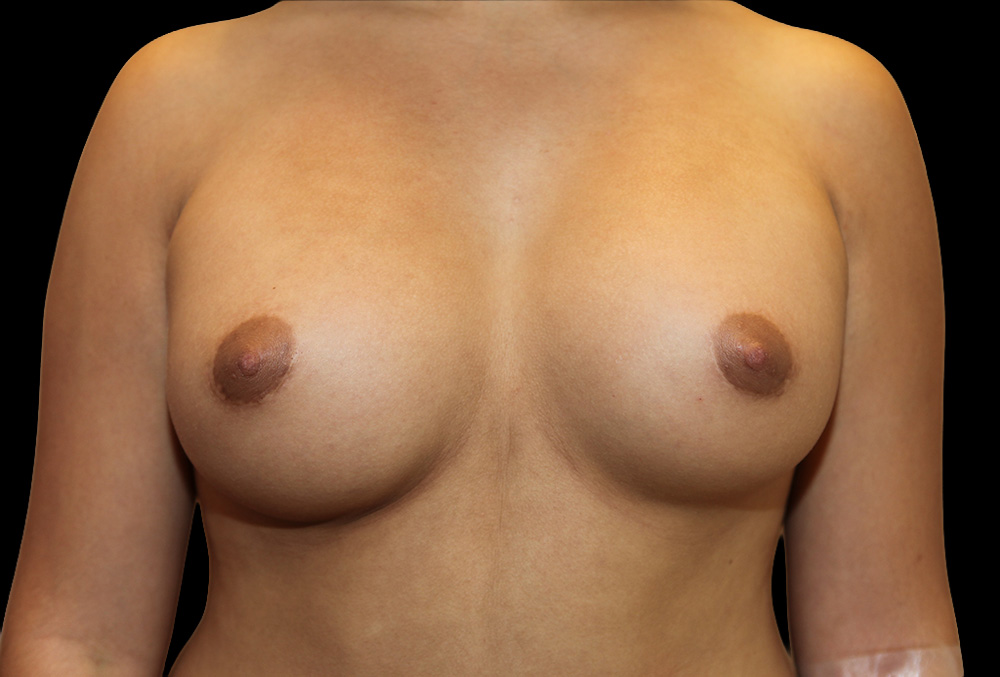 Case--2128 | Before Breast Implant Removal