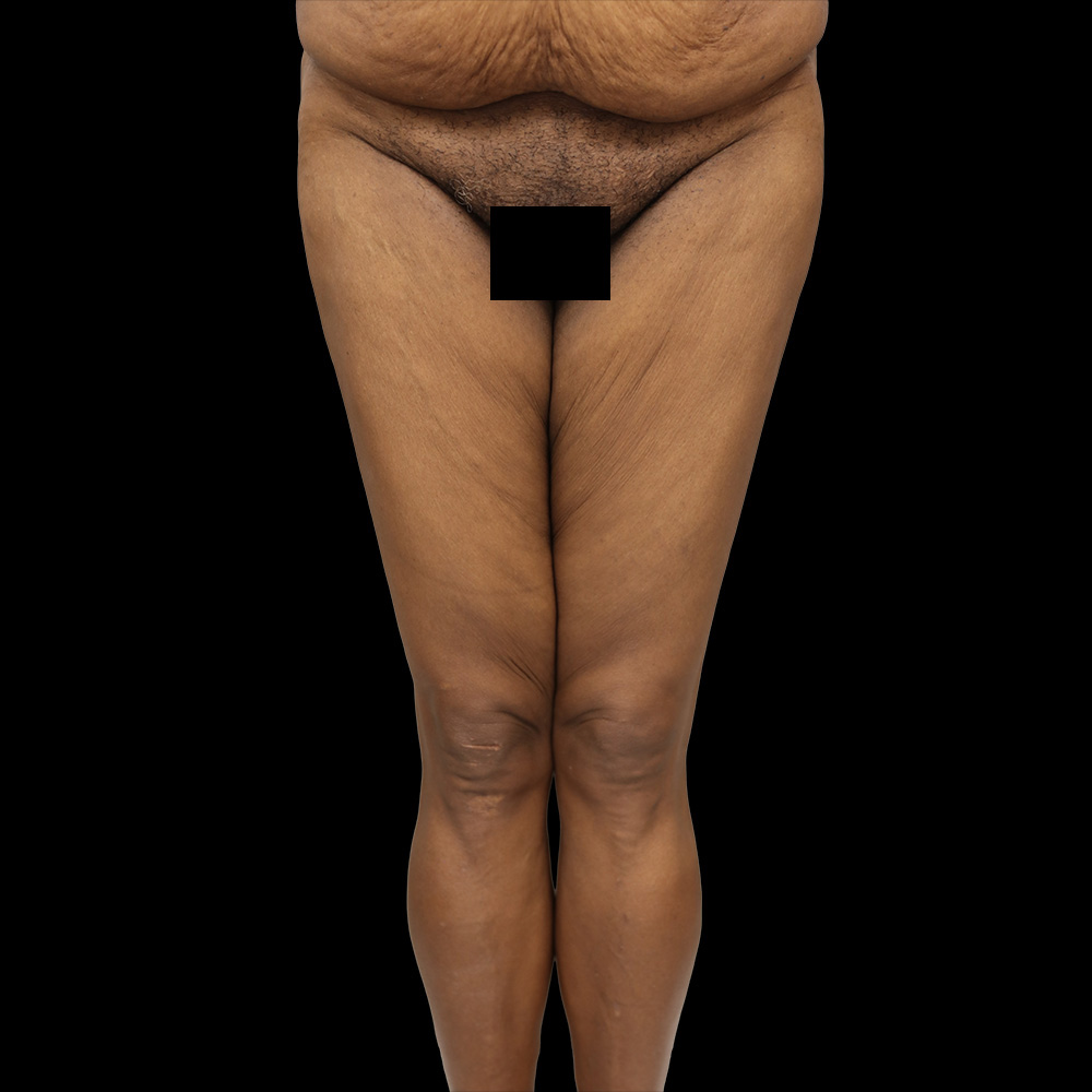 Case--4744 | Before Thigh Lift