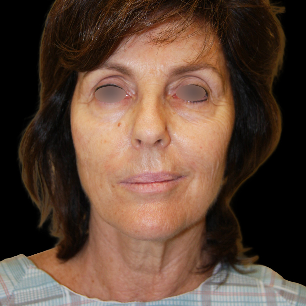 Case--9821 | Before Face and Neck Lift