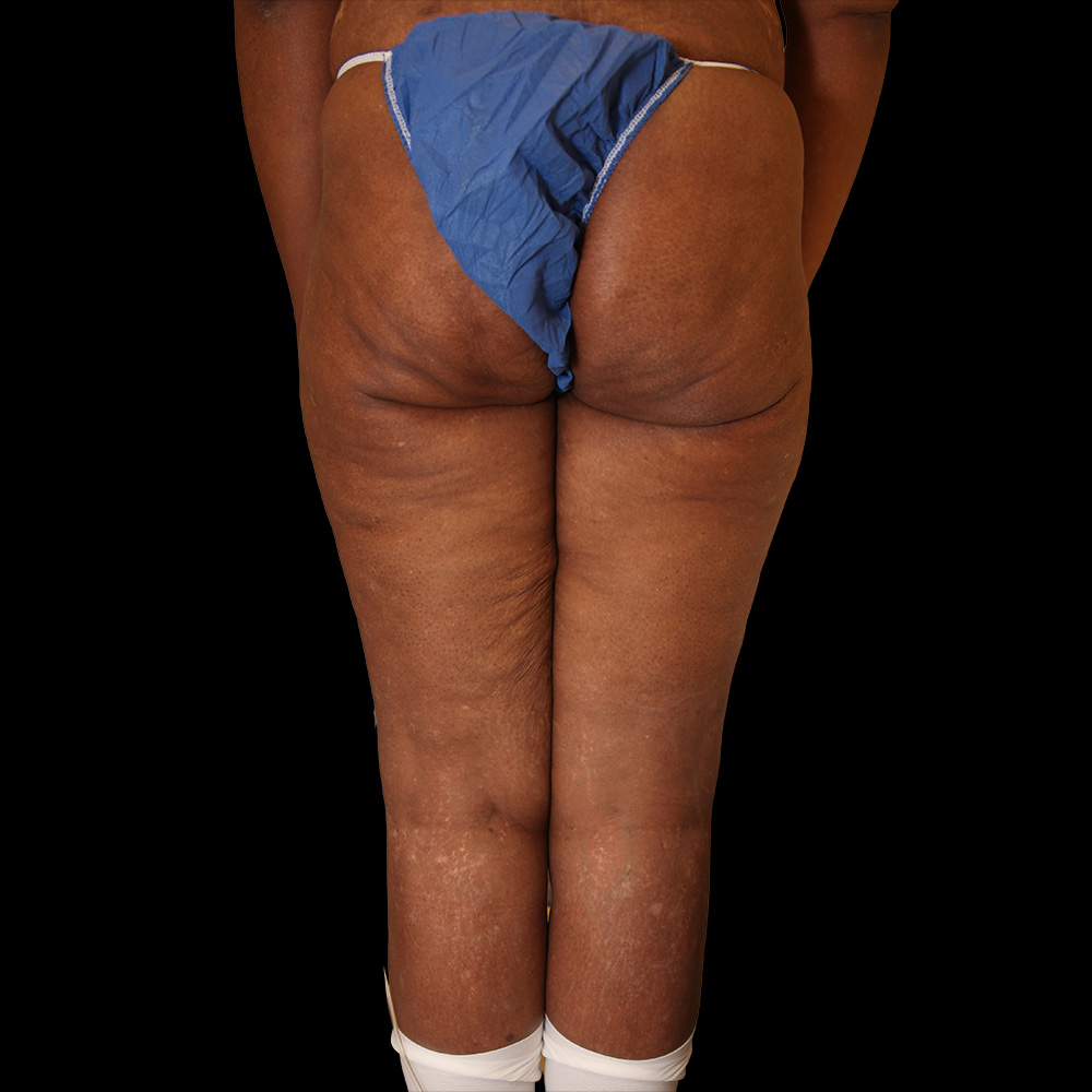 Case--8135 | Before Thigh Lift 2