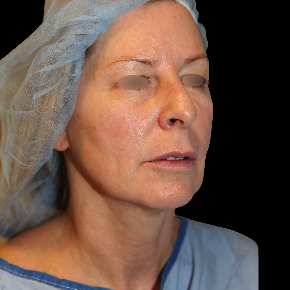 Case--7474 | Before Face and Neck Lift