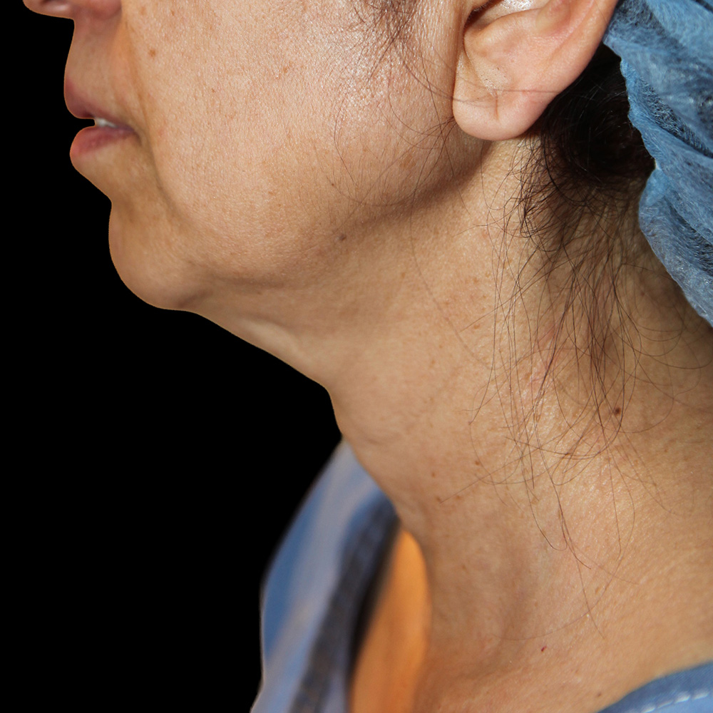 Case--2990 | Before Neck Lift
