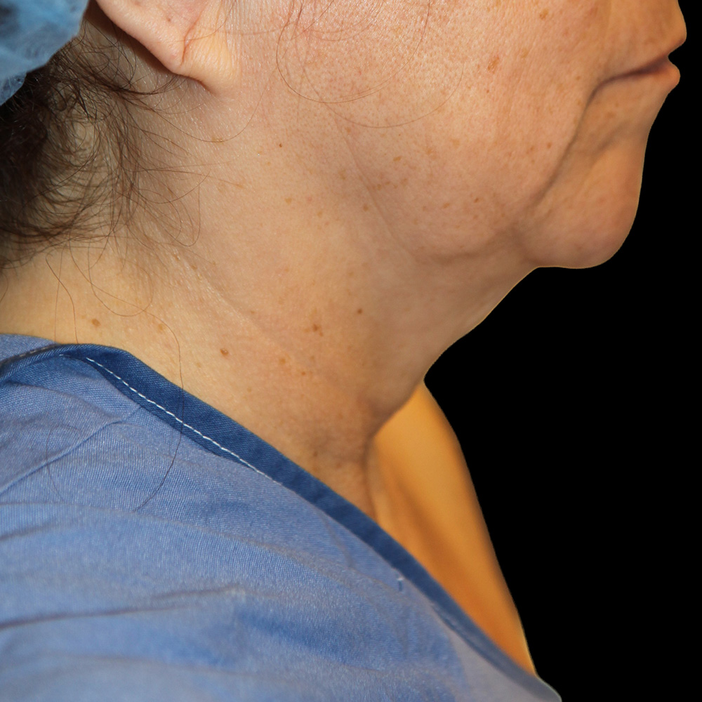 Case--6817 | Before Neck Lift