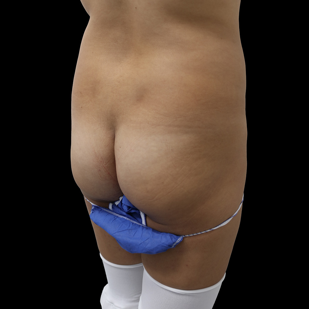 Case--7846 | Before Brazilian Butt Lift