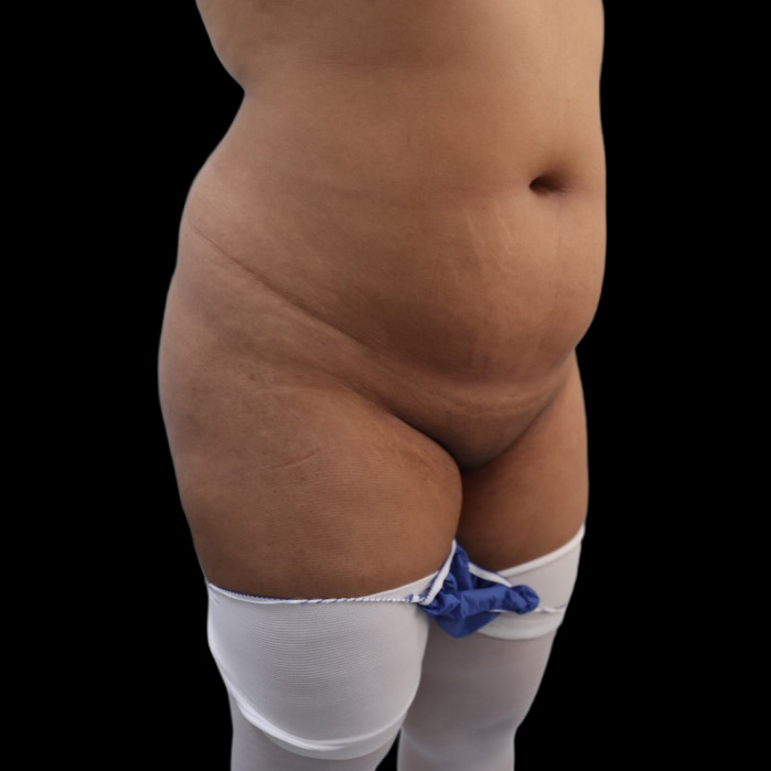 Case--5752 | Before Brazilian Butt Lift 3