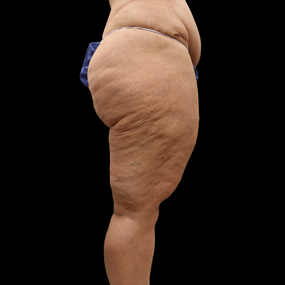 Case--3270 | Before Thigh Lift 3