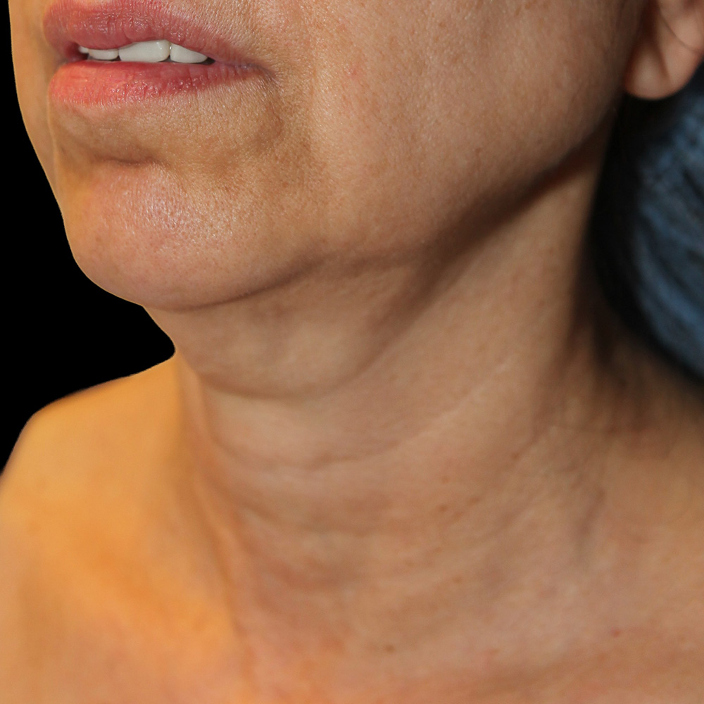 Case--2990 | Before Neck Lift 2