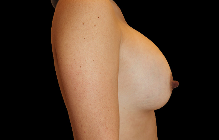 Case--6786 | Before Capsulectomy 3