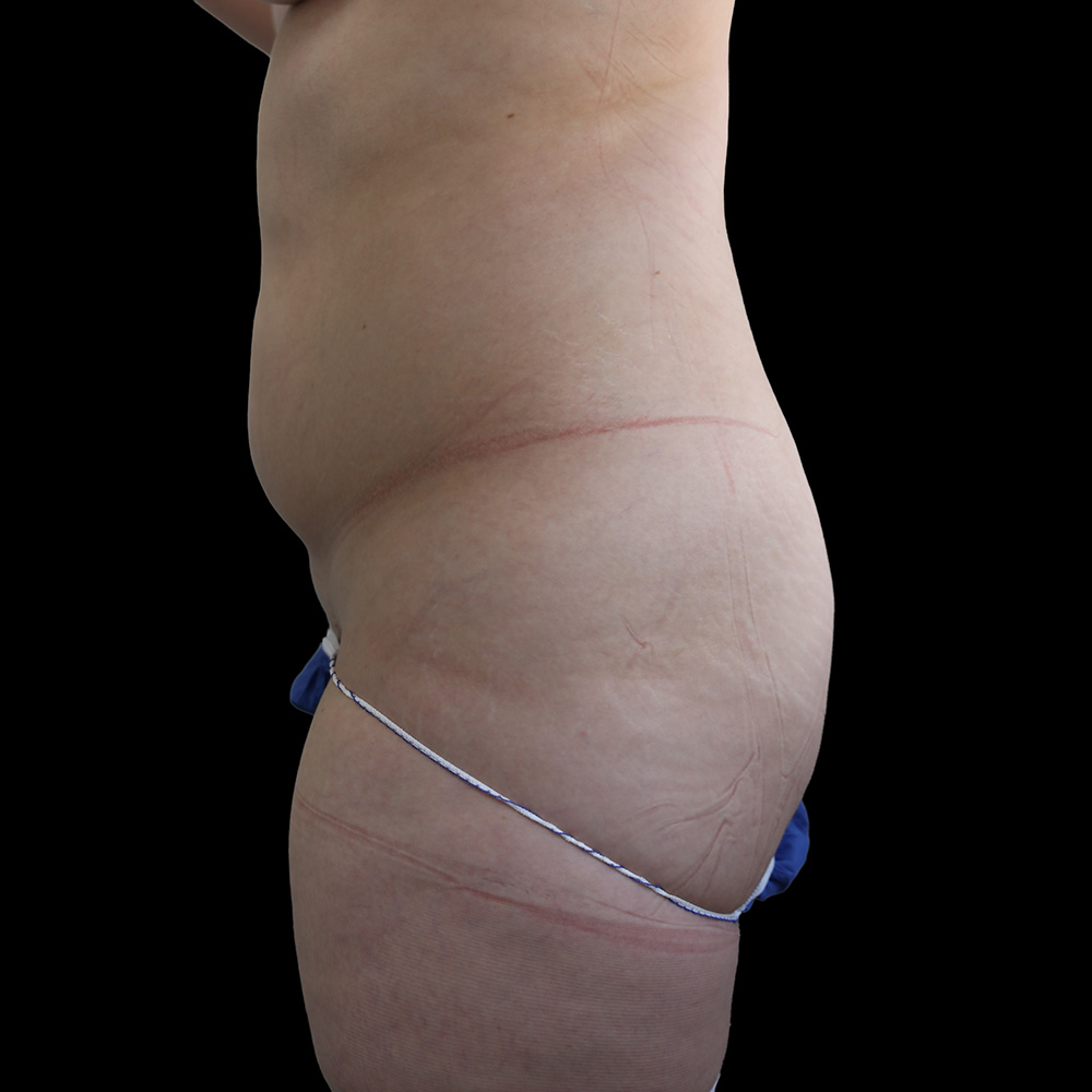 Case--9300 | Before Brazilian Butt Lift 4
