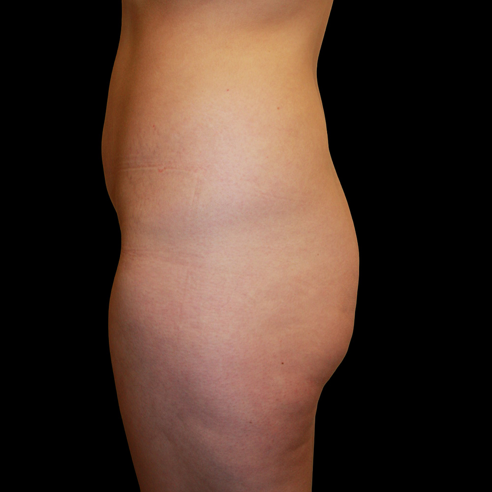 Case--9733 | Before Brazilian Butt Lift 4