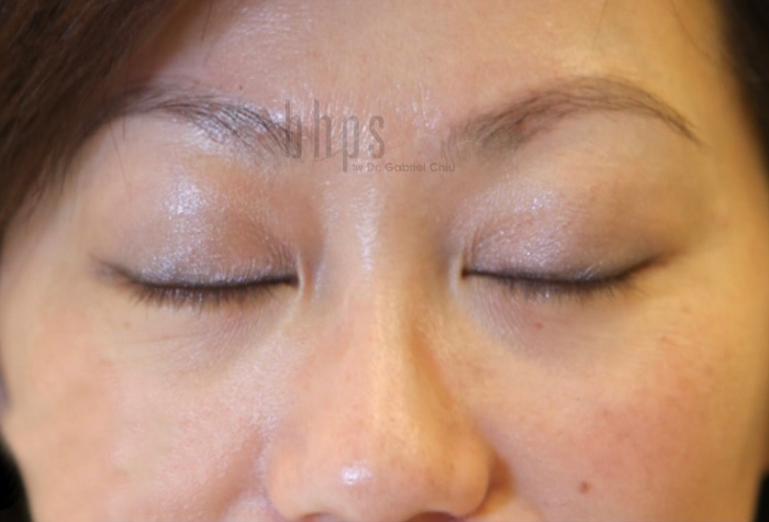 Eyelid Surgery Patient After - 2