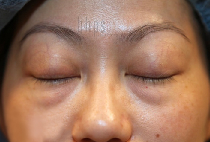 Eyelid Surgery Patient Before - 2