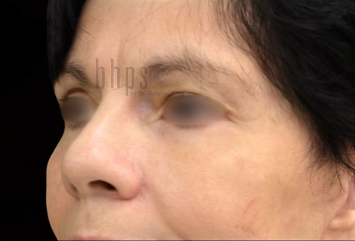 Case--7755 | After Blepharoplasty 2