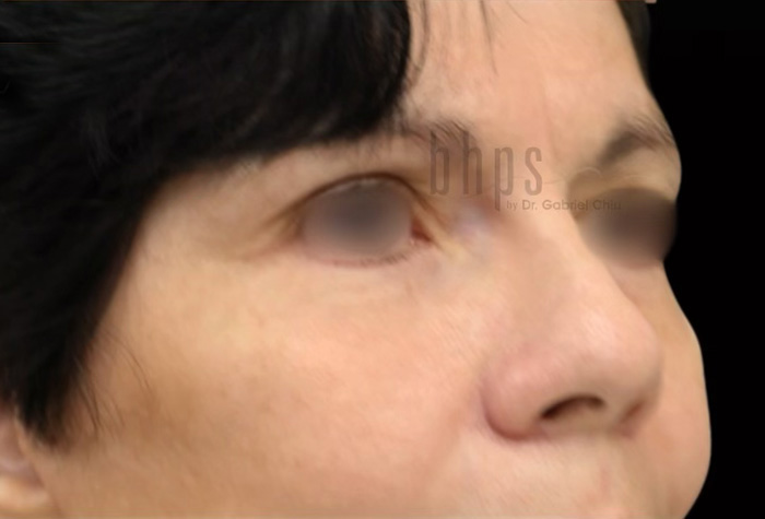 Case--7755 | After Blepharoplasty 3