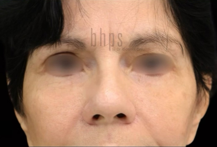 Eyelid Surgery Patient After - 1