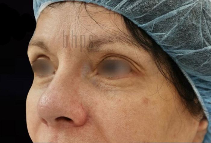 Case--7755 | Before Blepharoplasty 2