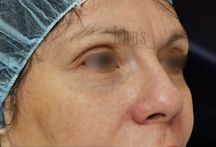 Case--7755 | Before Blepharoplasty 3