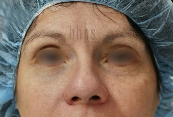 Eyelid Surgery Patient Before - 1