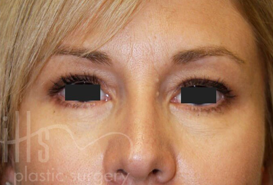 Case--6392 | After Face