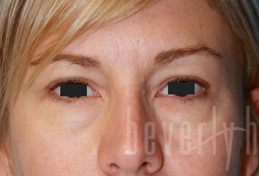 Case--6392 | Before Face