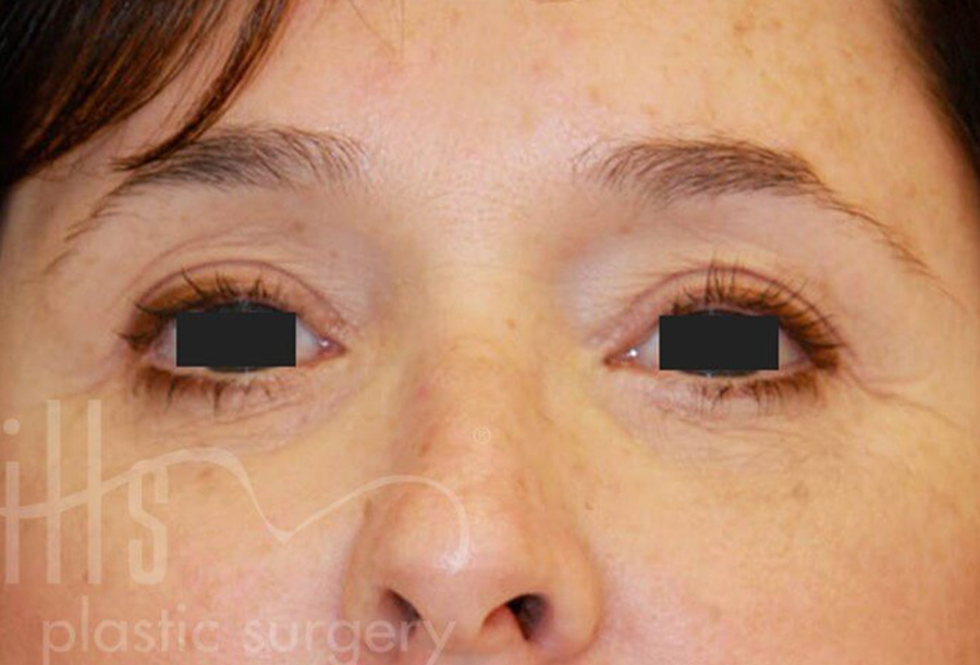 Case--9835 | After Face