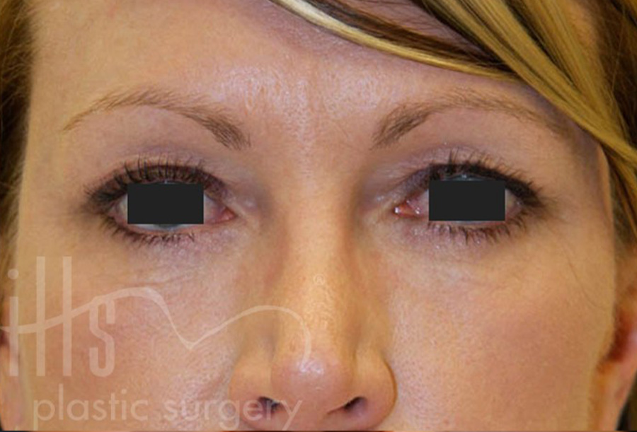 Case--2469 | After Face