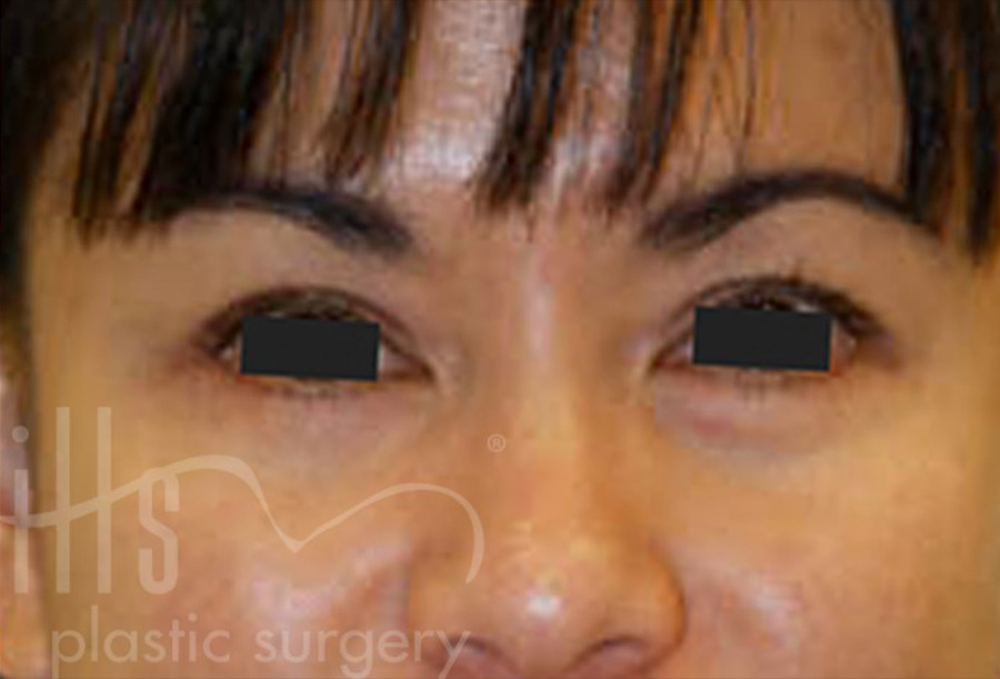 Case--5623 | After Face