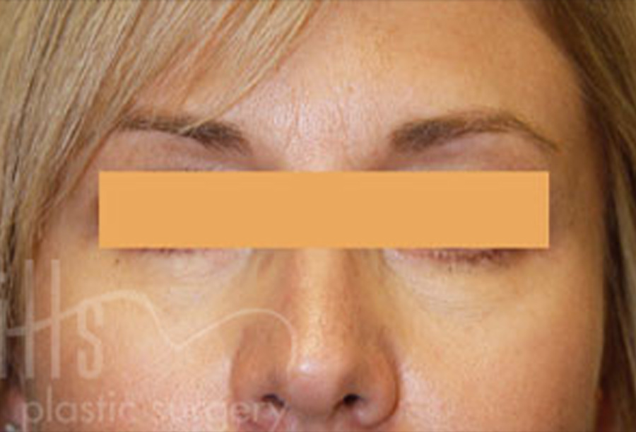 Case--4050 | After Face