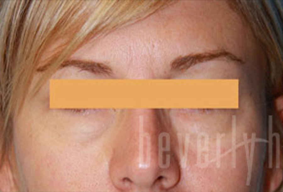 Case--4050 | Before Face