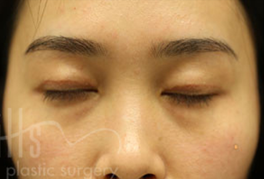 Case--1228 | After Blepharoplasty 2