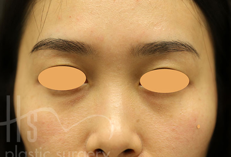 Case--1228 | After Face