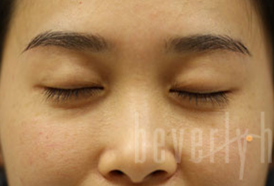 Case--1228 | Before Blepharoplasty 2