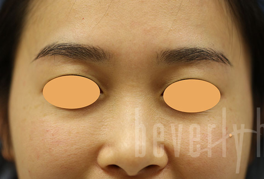 Case--1228 | Before Face