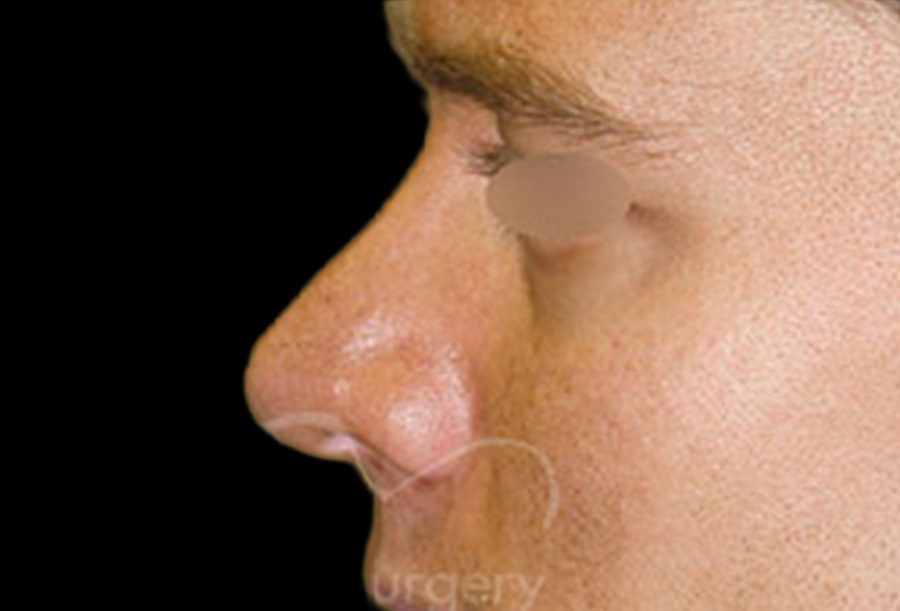 Case--2636 | After Face