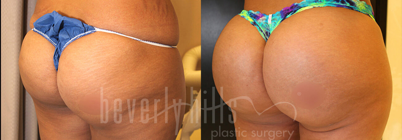 Brazilian Butt Lift Patient 34 Before & After