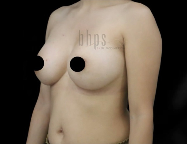 Case--3201 | After Breast Augmentation 2
