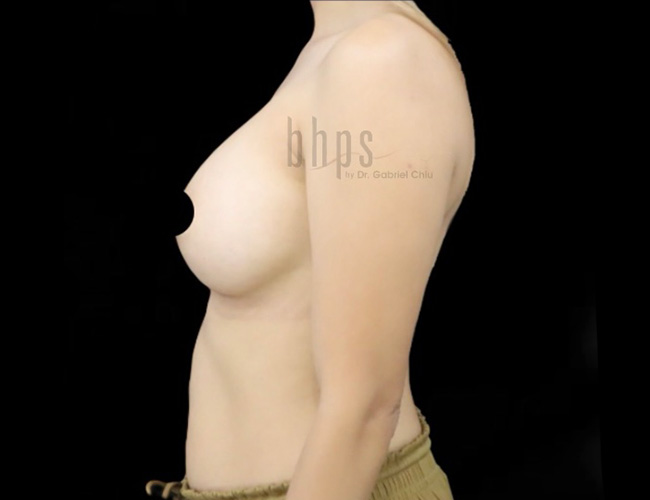 Case--3201 | After Breast Augmentation 3