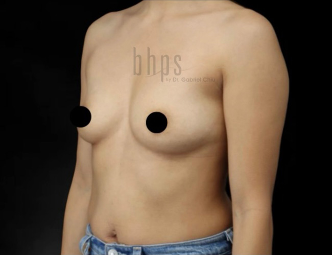 Case--3201 | Before Breast Augmentation 2