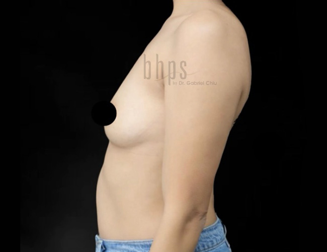 Case--3201 | Before Breast Augmentation 3