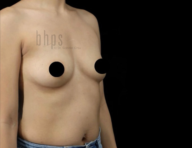 Case--3201 | Before Breast Augmentation 4