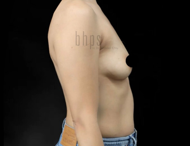Case--3201 | Before Breast Augmentation 5