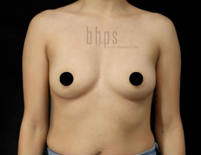 Breast Augmentation Patient Before - 1
