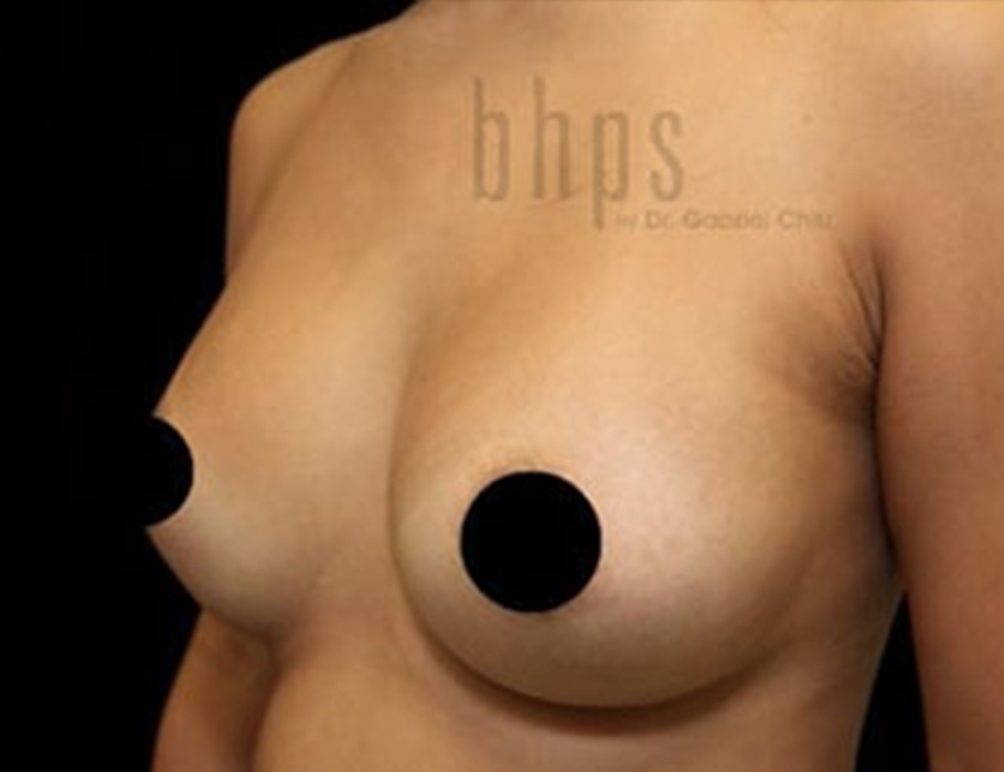 Case--9275 | After Breast Augmentation 3