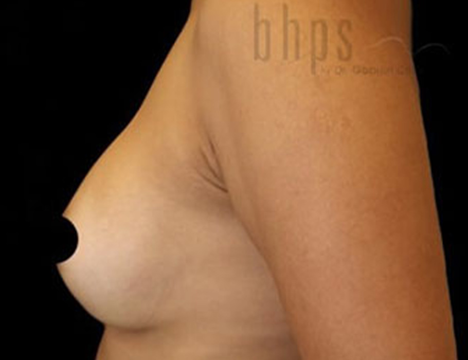Case--9275 | After Breast Augmentation 4